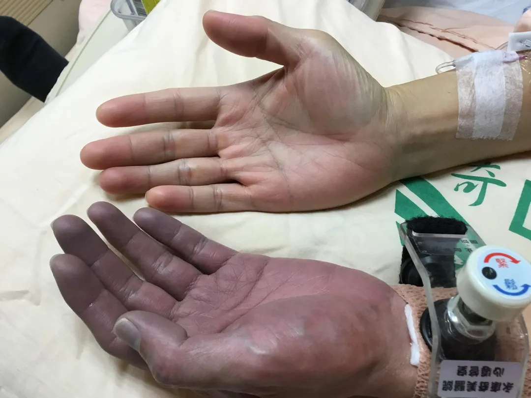 手掌血色回復較延遲，可能是先天血管較小或血管曾受過傷，如做過心導管。（圖／資料庫）