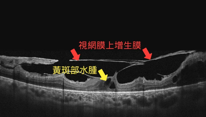 陳彥晟醫師呼籲糖尿病病友，應定期至眼科回診，避免造成不可逆的視力損害。（圖／恩主公醫院提供）