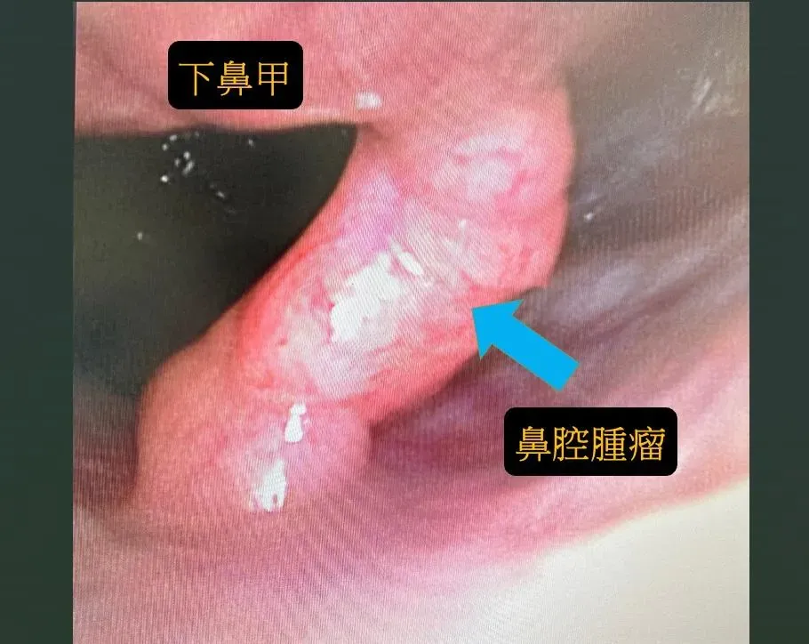 下鼻甲長出腫瘤(圖/耳鼻喉科 張弘醫師)