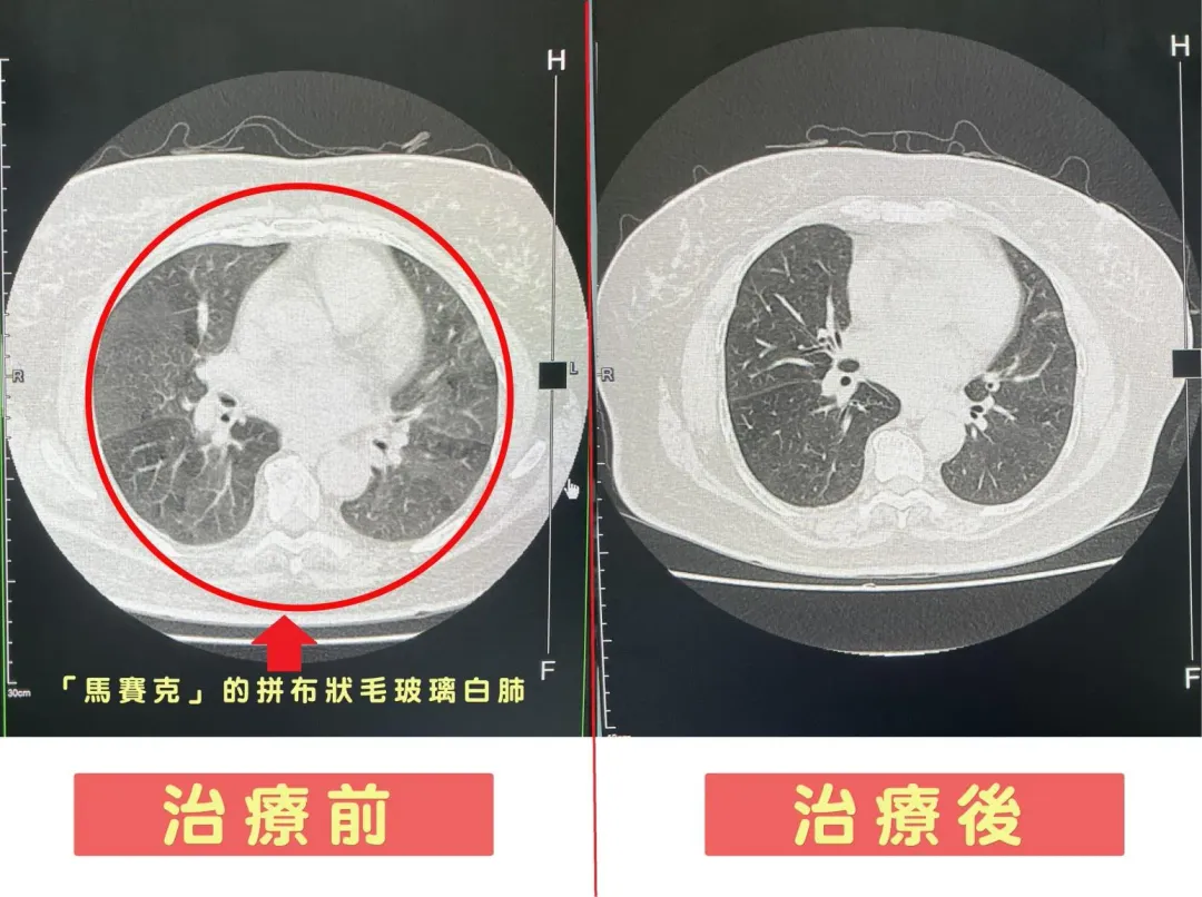 電腦斷層掃描治療前後比較。(圖/烏日林新醫院提供)