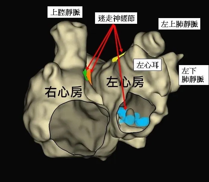 迷走神經節是長在心臟的表面,神經節是一個屬於不可再生的組織。(圖/中國醫藥大學新竹附設醫院提供)
