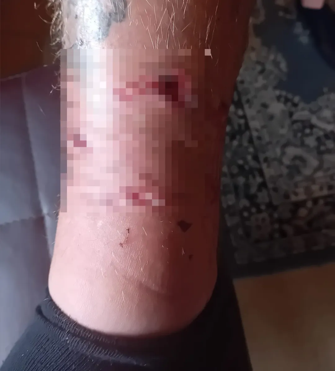 該名飼主命令惡霸犬攻擊奇茲克，惡霸犬在他的腿上留下多處傷口。（圖／翻攝自Facebook@Ben Francis Cźyżyk）