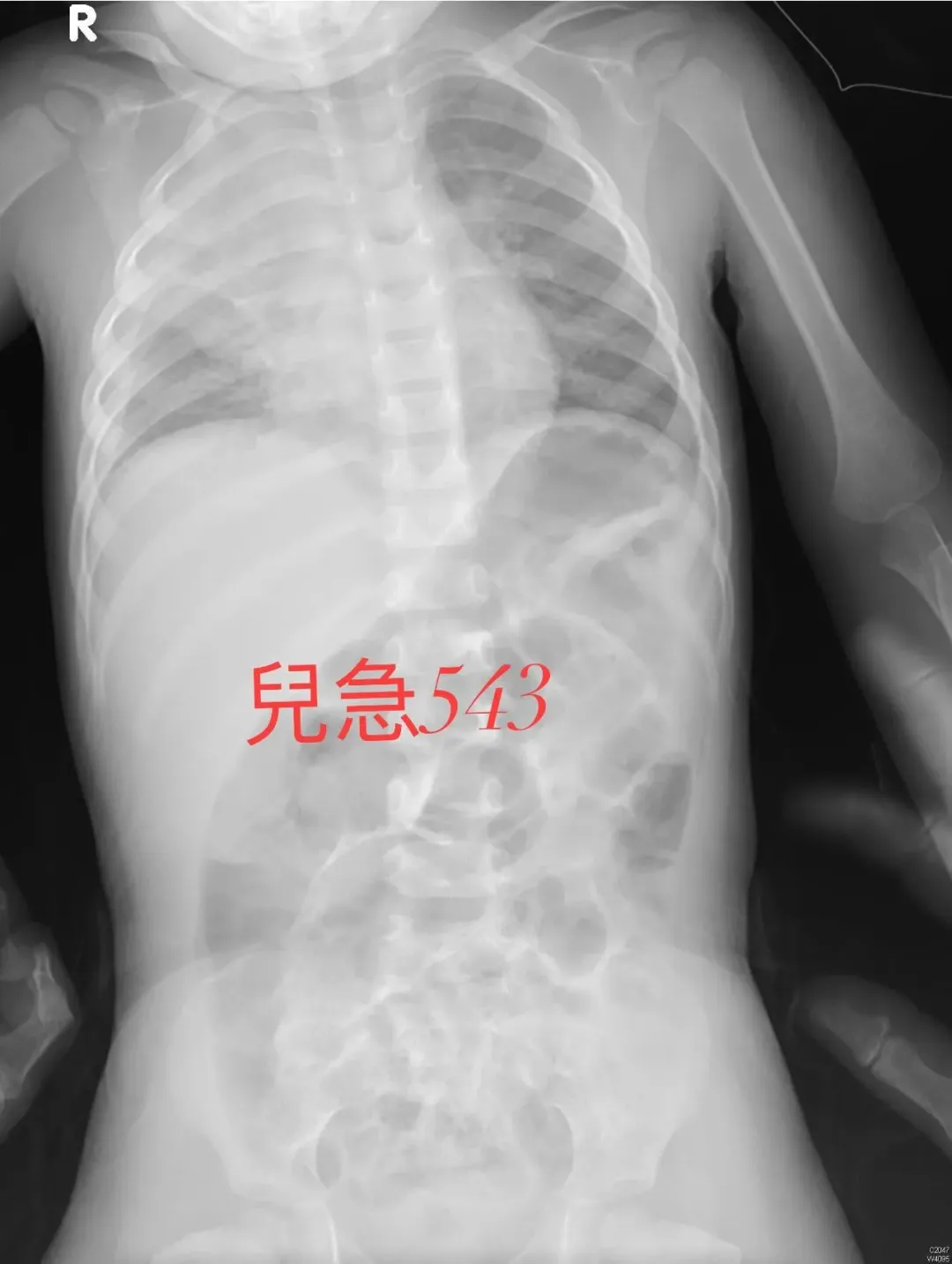 不少病毒正流行著,尤其是RSV,有些小孩症狀都很嚴重,如圖肺炎。(圖/來講兒科急診的543-吳昌騰醫師)