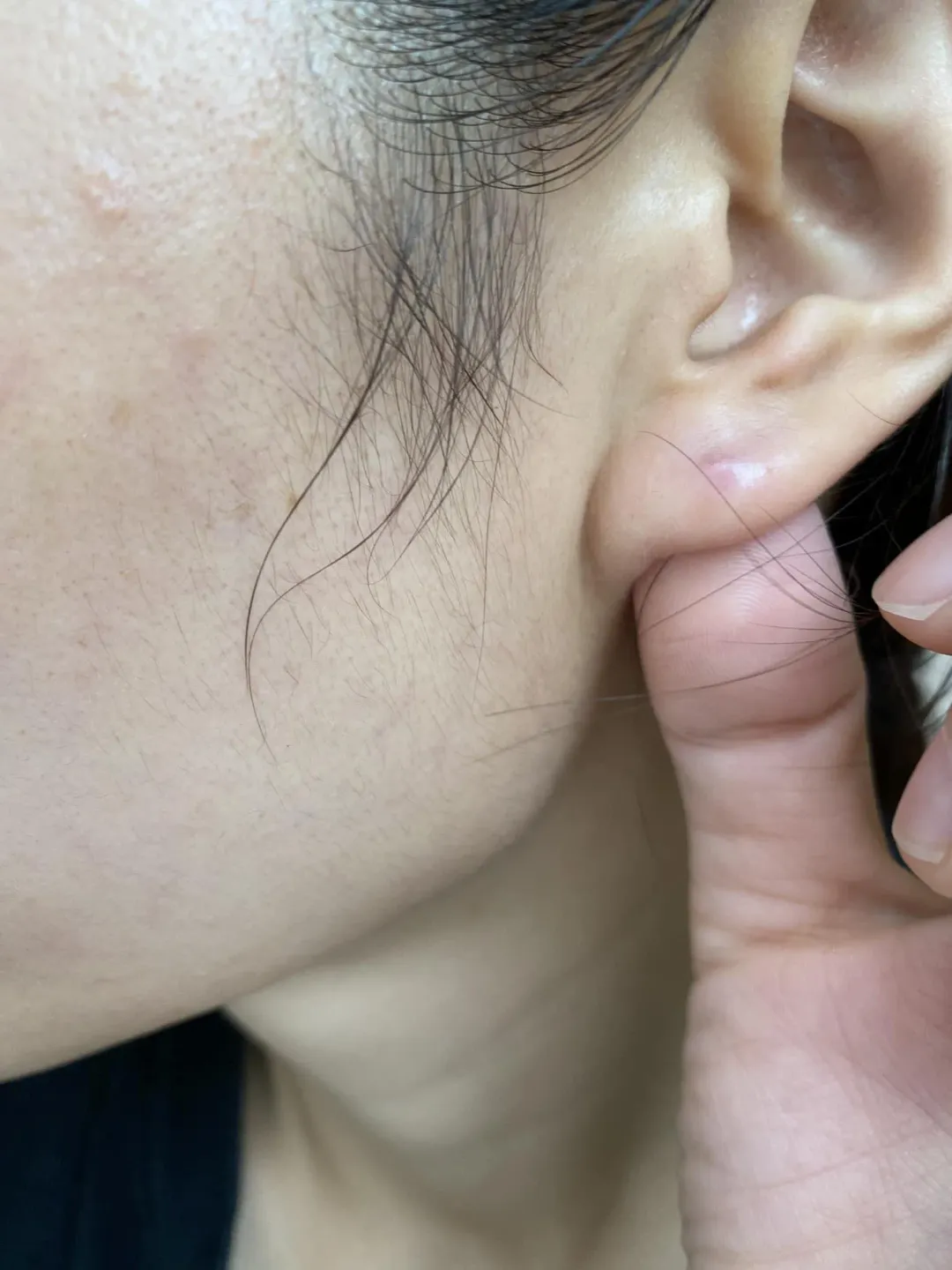 耳朵或耳垂附近莫名其妙長出腫腫的小豆學名叫做「表皮囊腫」。(圖/整形外科醫師朱育瑩的手札)