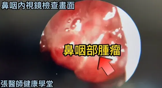 男子鼻咽內視鏡畫面。（圖／翻攝自YouTube《張醫師健康學堂》）