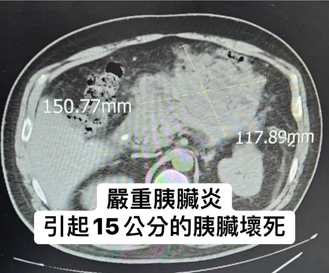 「急性胰臟炎」可說是他最害怕的疾病,尤其是「壞死性胰臟炎」。(圖/胰臟醫師 林相宏 禾馨民權內科診所)