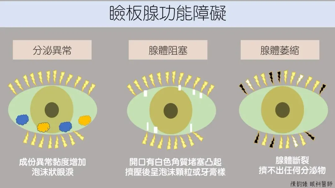 瞼板腺若是分泌油的量太少、油的品質不好,或是眨眼不完全造成油無法順利分泌,都會造成淚水的油脂層功能不佳。(圖/陳韵臻醫師|眼科學研究室)
