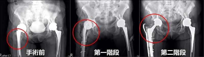亞大醫院替王奶奶安排階段性再翻修手術。(圖/亞大附醫)