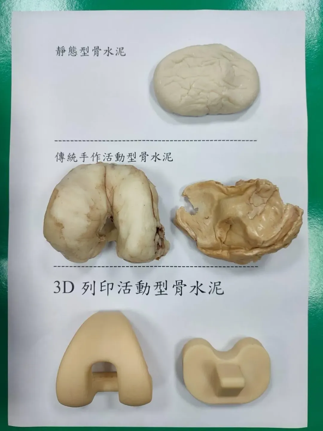 傳統手作、翻模或市售活動型骨水泥因設計上較粗糙或力學不穩定，產生不少骨水泥相關的機械性併發症。（圖／中國醫藥大學附設醫院提供）