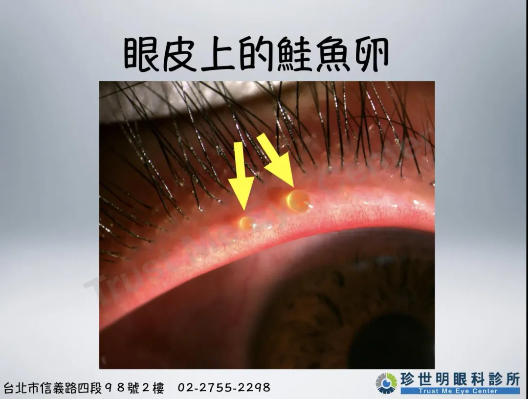 眼皮上的鮭魚卵。（圖／王孟祺醫師-眼科最前線）