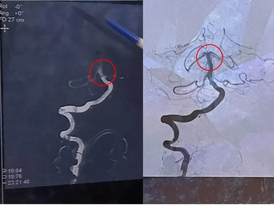 紅圈標示為阻塞血管(左)及血栓取出後血管(右)。