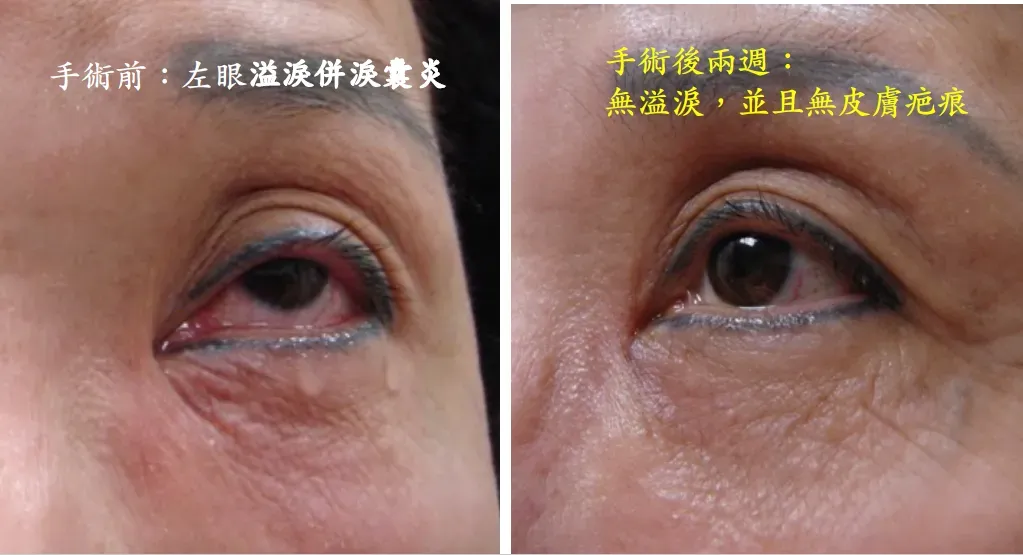 內視鏡鼻腔淚囊造口術。（圖／亞東醫院提供）