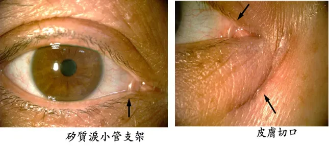 外開式鼻腔淚囊造口術。（圖／亞東醫院提供）