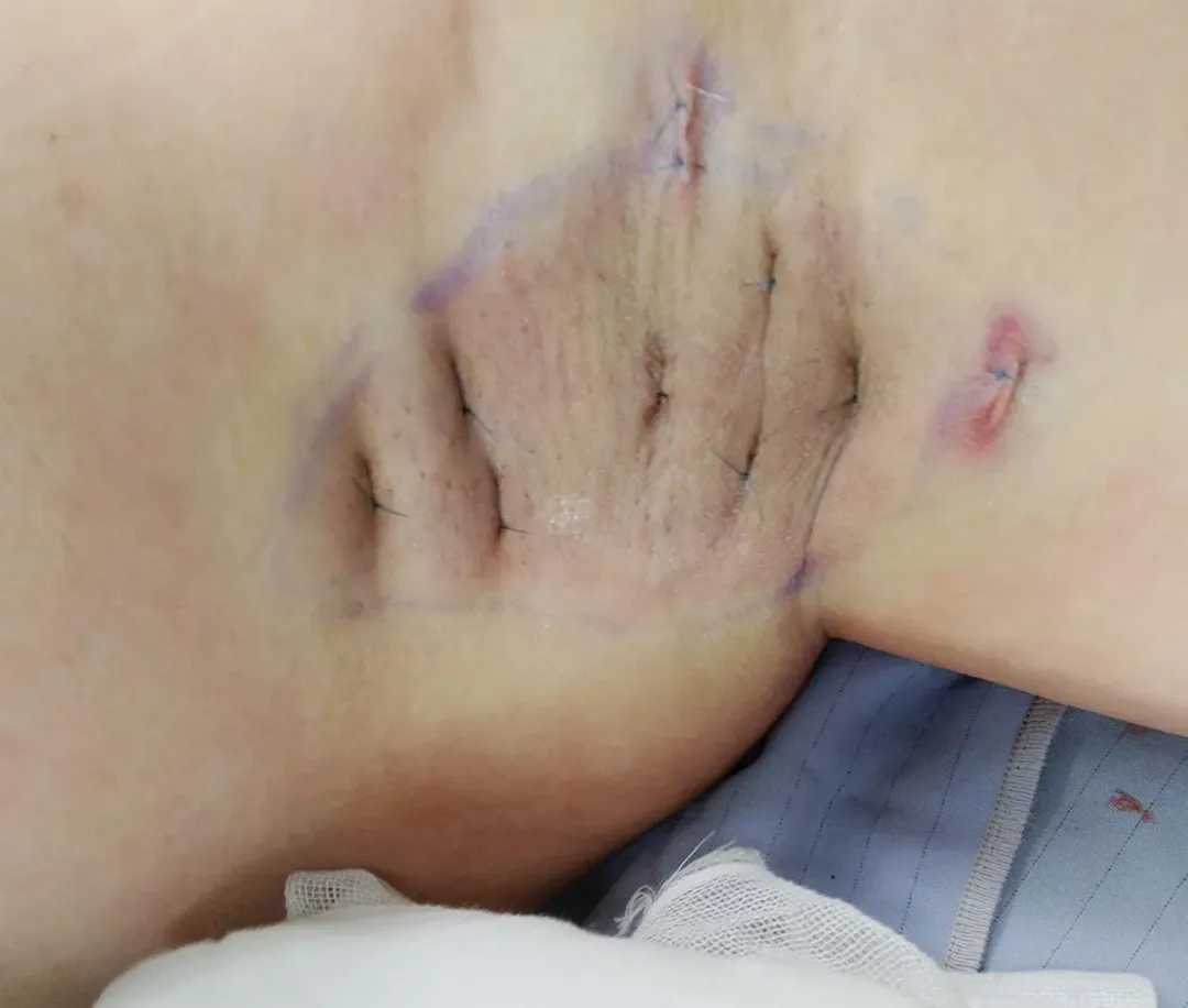 女大學生嚴重狐臭 腋下頂漿腺作怪。(圖/澄清醫院提供)