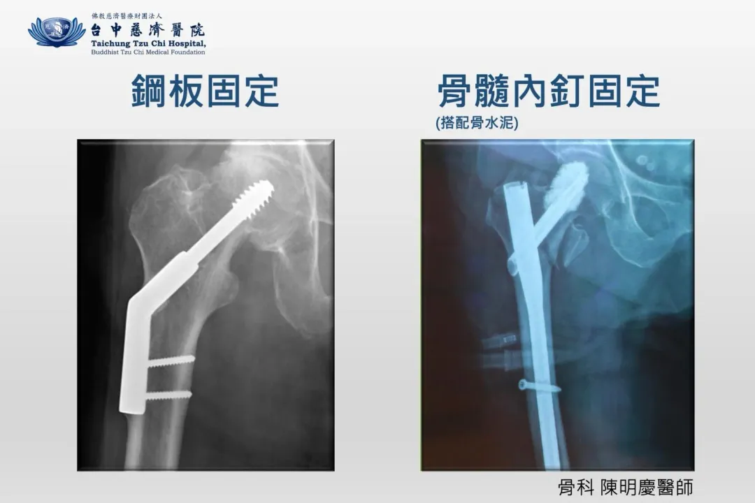 鋼板與骨髓內釘固定Ｘ光片對照。（圖／台中慈濟醫院提供）