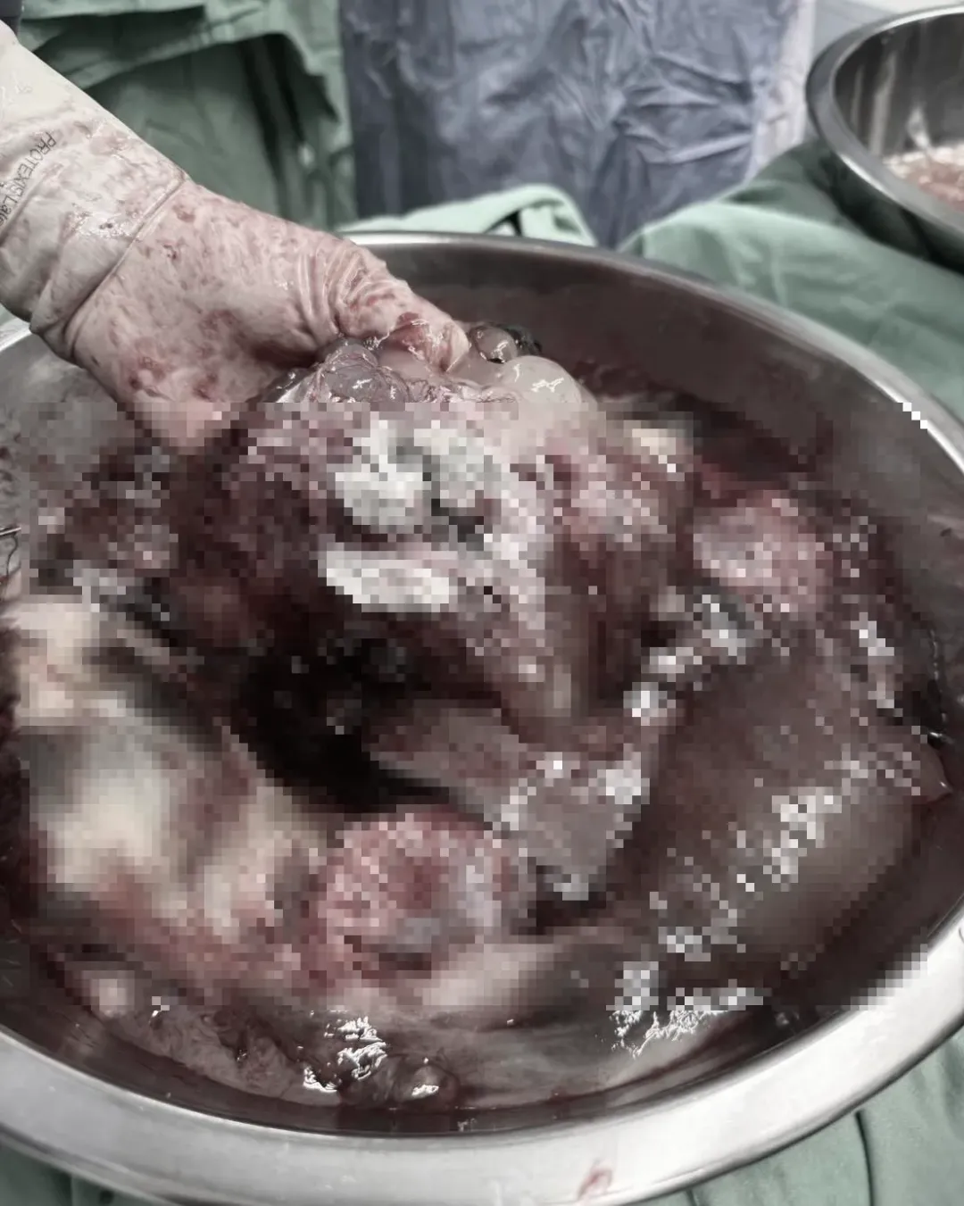 卵巢腫瘤破了大洞，腸子跟腹腔內臟全包圍在黏液裡，黏液細胞跑到內臟器官表面寄生，形成假性黏液瘤。（圖／李偉浩臉書）