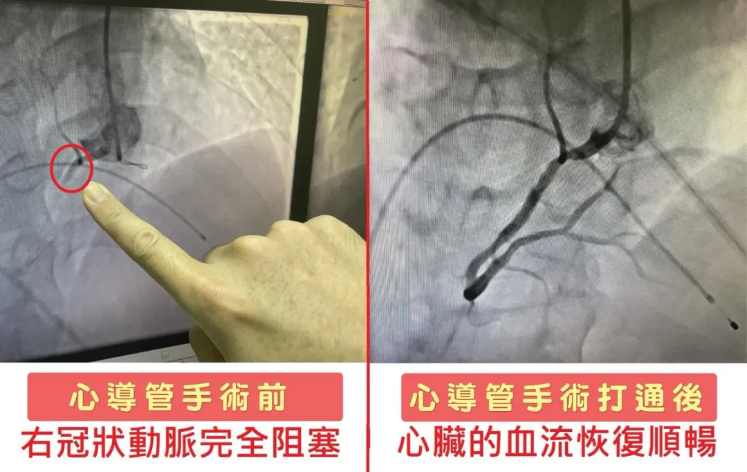 心導管手術－心臟血管術前堵塞及術後恢復通暢的畫面。（圖／烏日林新醫院提供）