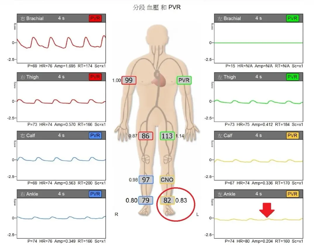 患者左腳踝ABI值偏低，且脈搏明顯偏弱，是周邊動脈阻塞症狀之一。（圖／亞大醫院提供）