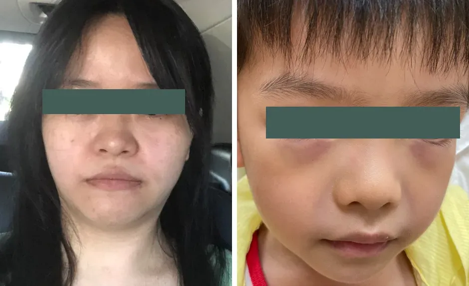 過敏性鼻炎易產生鼻塞或鼻涕倒流所致黑眼圈、下眼瞼橫紋、眼下浮腫、鼻梁上橫摺等面容變化。（圖／安南醫院提供）