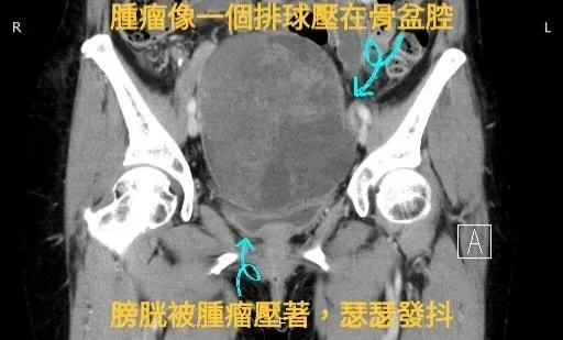 婦人有巨大的「骨盆腔腫瘤」加上轉移造成的「腹水」。(圖/戴定恩醫師臉書)