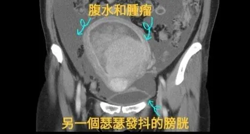 超音波一照更出現驚人「15公分大的腫瘤」,就像是山頂滑落的巨石跳出在螢幕上。(圖/戴定恩醫師臉書)