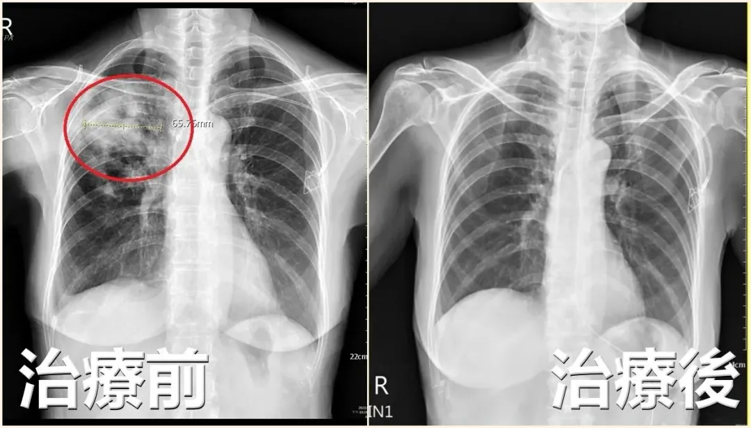 患者X光檢查影像顯示右上肺葉發炎,宛如「開了一個洞」。(圖/亞大醫院提供)