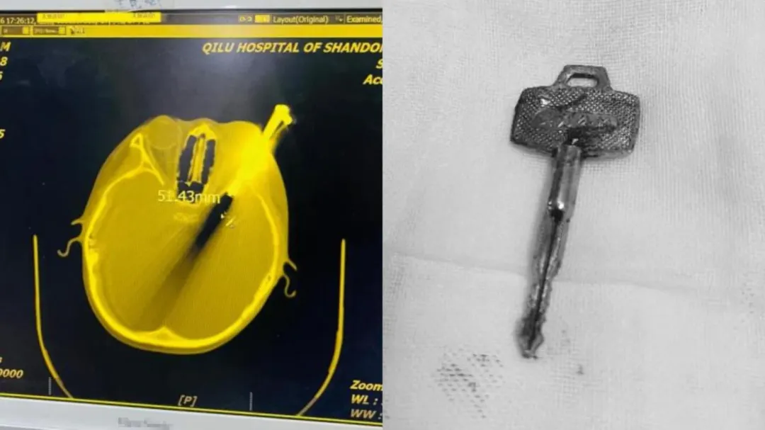 10歲男童聰聰跌倒重摔眼睛爆血, 電腦斷層證實, 顱內被插入5公分的鑰匙。(圖/翻攝百度)