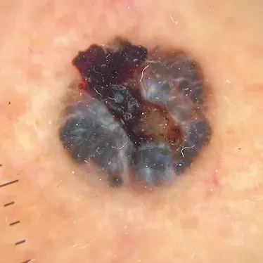皮膚惡性腫瘤：基底細胞癌。（圖／北市聯醫提供）