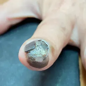 皮膚惡性腫瘤：黑色素細胞癌。（圖／北市聯醫提供）