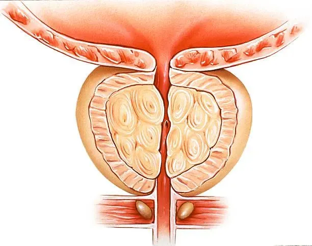 攝護腺癌的好發年紀較晚，個案多集中在60歲以上男性。（圖／資料庫）