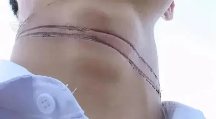 外送員脖子上的傷痕讓人看了怵目驚心。（圖／百度）