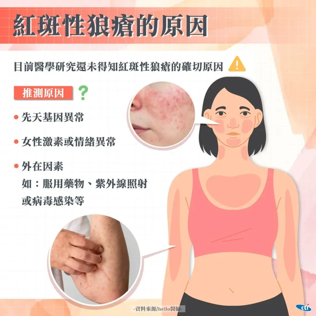 紅斑性狼瘡致病原因。