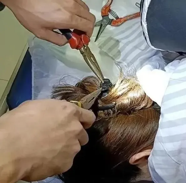 鯊魚夾插進女子頭皮,救援人員利用工具拔出來。(圖/百度)