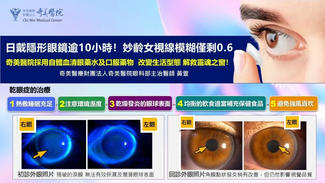 一名30歲上班族每天戴隱形眼鏡皆長達10小時以上,就醫檢查確診為乾眼症。(圖/奇美醫院提供)