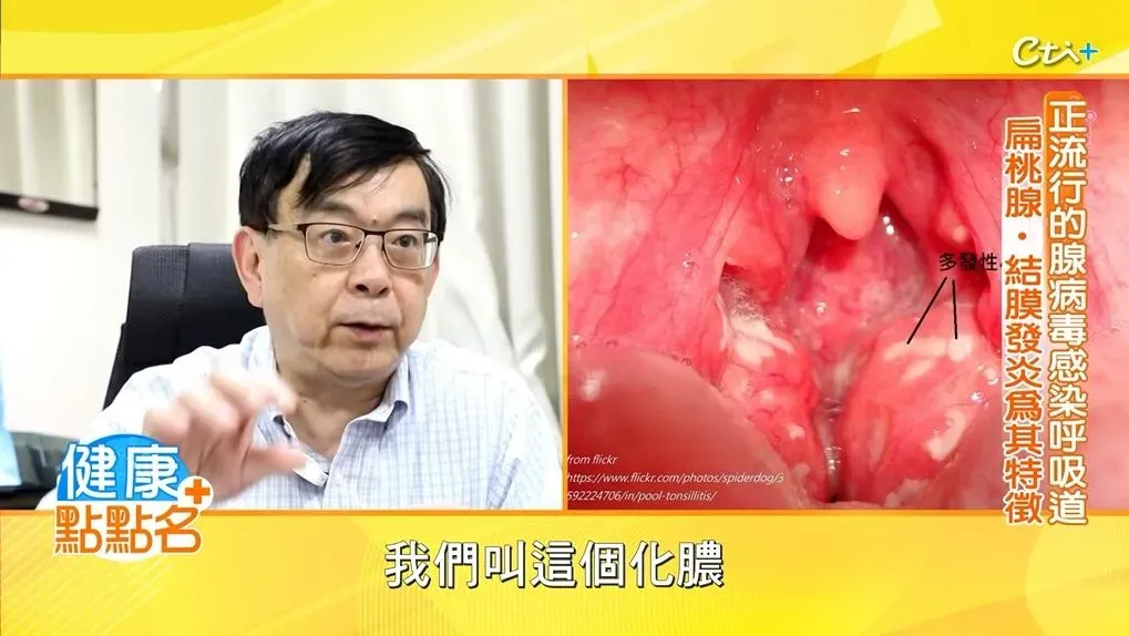 這一波造成流行的腺病毒，主要會造成呼吸道的嚴重發炎，典型症狀是喉嚨紅腫、眼睛結膜炎、持續發燒5-7天，同時咳嗽、流鼻水會相當明顯。（圖／《健康點點名》）