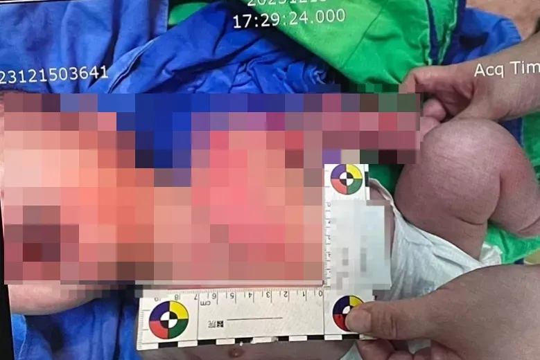 才3個月大的嬰兒遭托嬰中心嚴重燙傷。(圖/翻攝畫面)