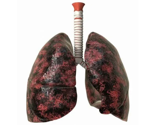 肺癌早期病徵不明顯,胸部X光檢查受限死角,很難發現低於1公分以下腫瘤。(示意圖/photo AC)