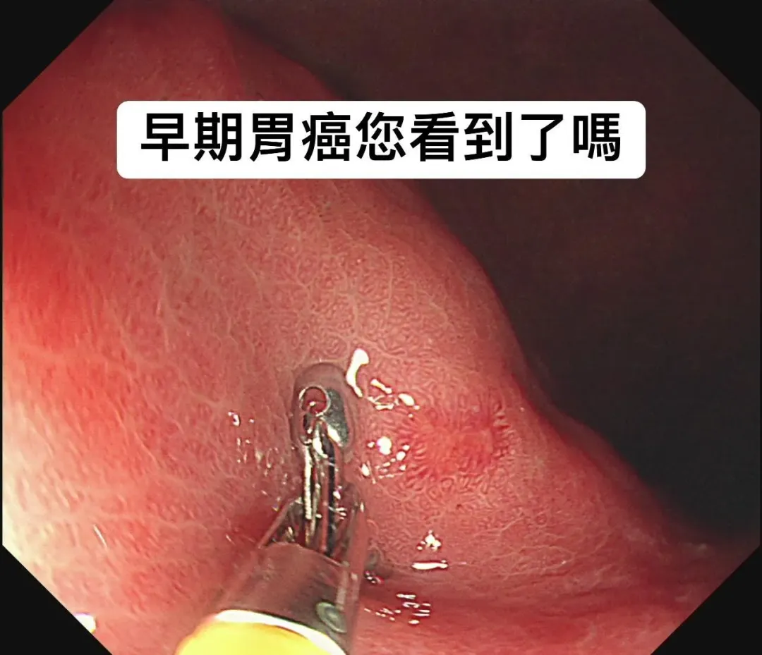 林相宏發現病患胃壁上有一個0.5公分的不規則扁平隆起。(圖/林相宏臉書)