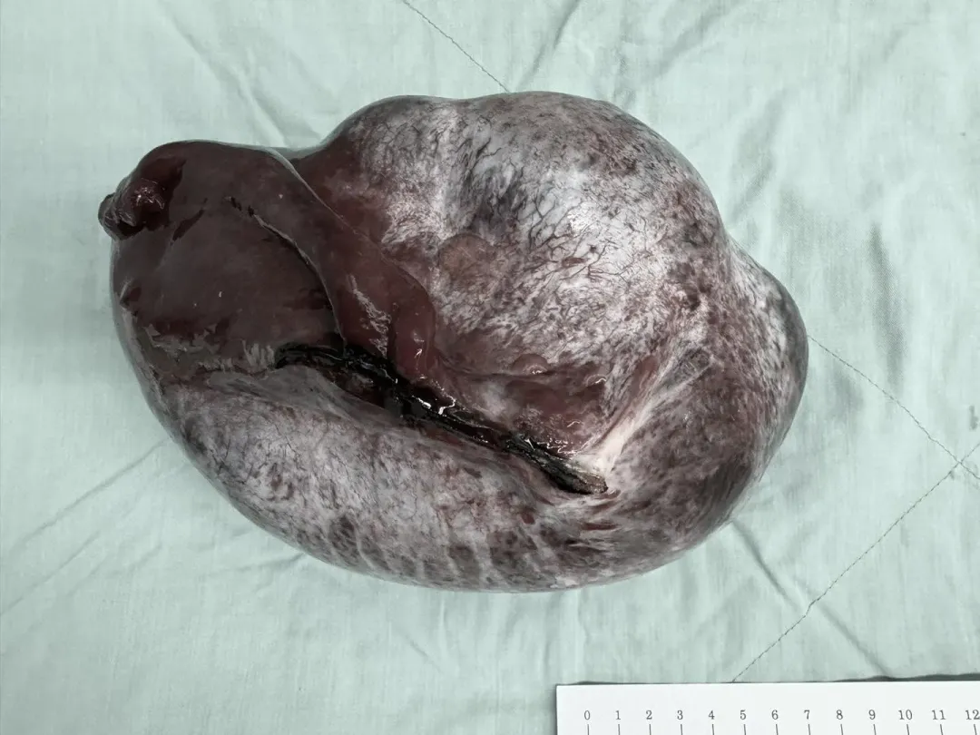 「成熟型畸胎瘤」常出現頭髮、油脂、皮膚、軟骨、牙齒及骨頭等器官組織。(圖/翻攝自【Dr. 李偉浩 的 婦科手術室】臉書粉專)