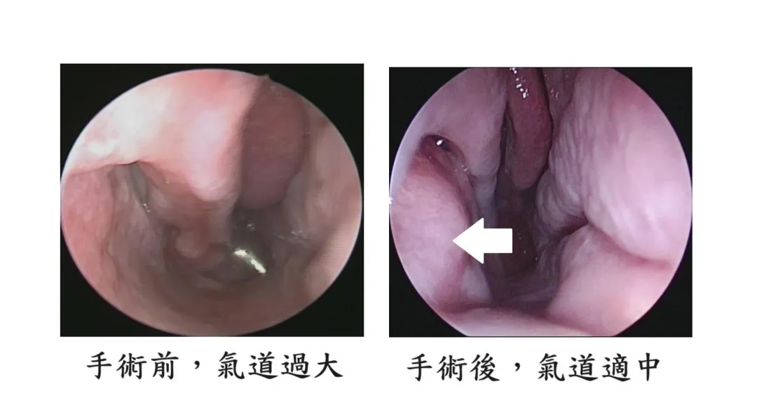 空鼻症病患手術前(左圖)與手術後(右圖)鼻腔內視鏡影像。箭頭:手術重建部位。(圖/林口長庚醫院提供)