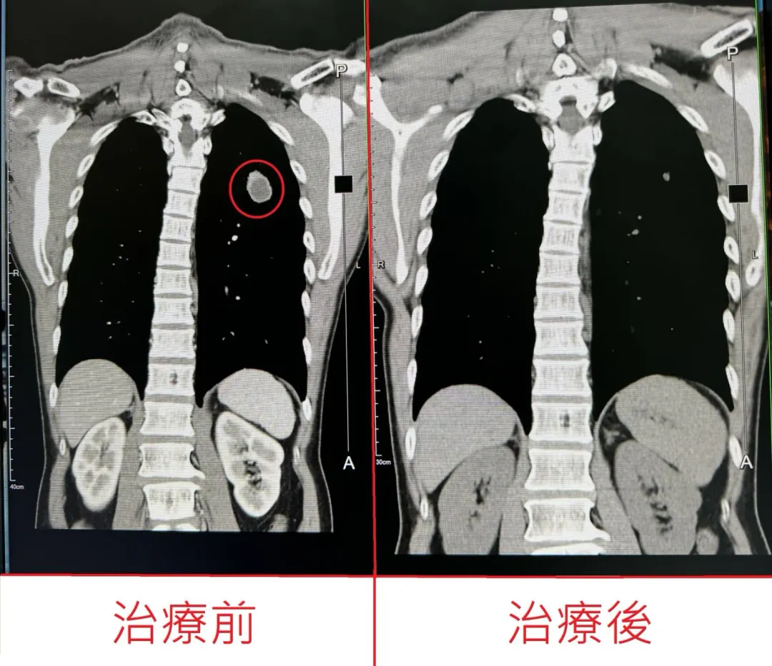 電腦斷層掃描檢查治療前後-原有左上肺有3.5公分腫塊，治療後成功消滅只剩疤痕。（圖／烏日林新醫院提供）