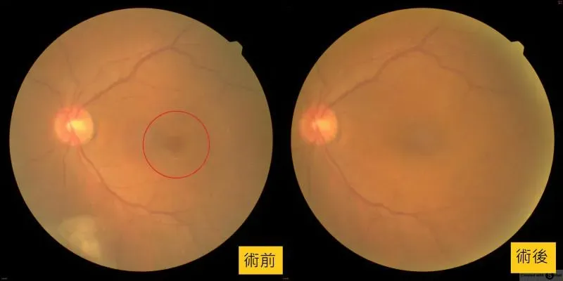60多歲陳姓男子,眼前出現黑影,眼底攝影照顯示,黃斑部出現裂孔。(圖/彭書昱)