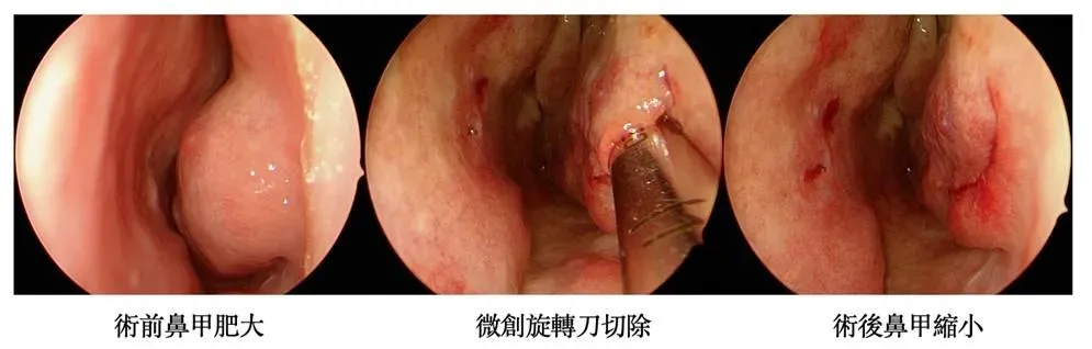微創旋轉刀切除。（圖／台中中山附醫提供）