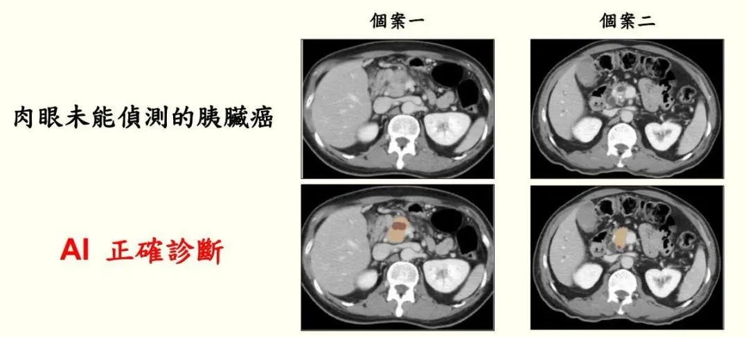 小於2公分、還未轉移時就診斷胰臟癌,治癒率高達8成,但早期胰臟癌在電腦斷層檢查上肉眼無法分辨。(圖/臺大醫院提供)