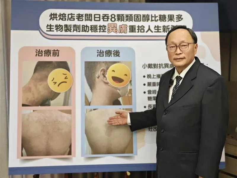 賴寧生表示，中重度異位性皮膚炎治療不但要趁早，更要重視有效性與安全性。（圖／大林慈濟醫院提供）