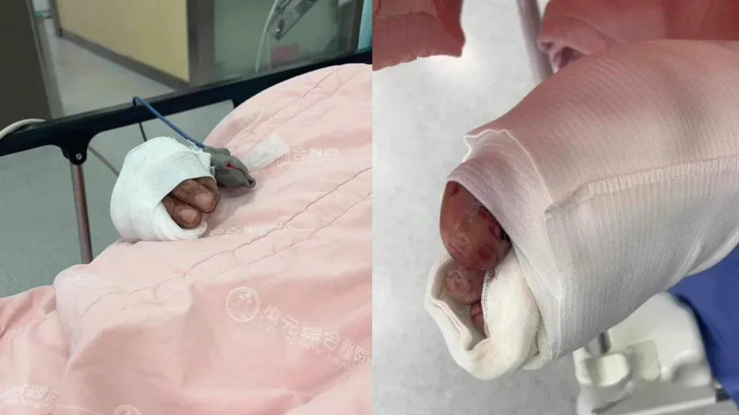 受害人聶姓男子遭人砍斷右手小指，左腳底也有切割傷。（圖／翻攝臉書我是湖口人）