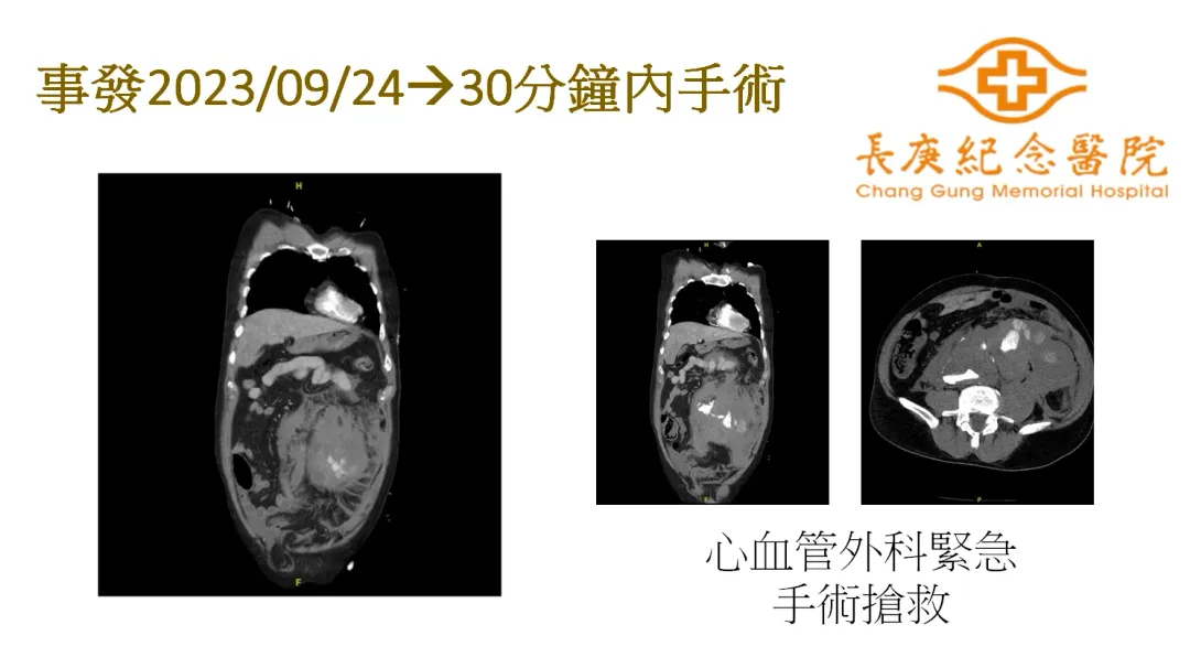 徐伯伯腹部腫大「比懷孕婦女還大」，必須緊急開刀處置。（圖／長庚醫院提供）
