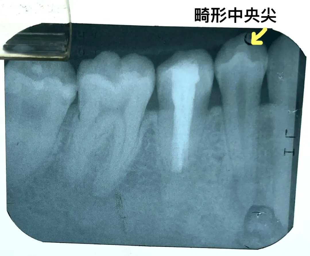 畸形中央尖。（示意圖／徐維敏醫師提供）