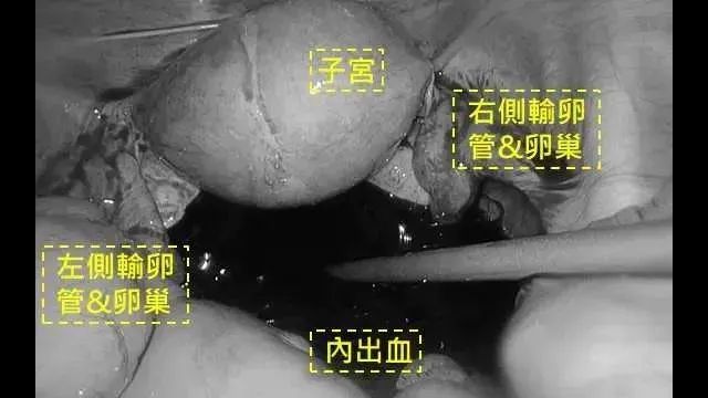 女子肚子痛爆送醫驚見「滿肚子鮮血」。