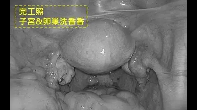 最後整個腹腔內的出血是1500ml。